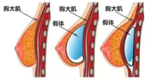 隆胸1 (3).png