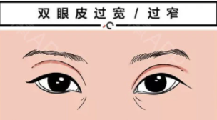 雙眼皮17 (2).png